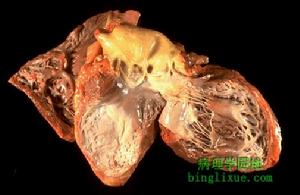 心肌梗塞並發左心室室壁瘤