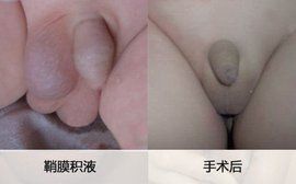 鞘膜積液手術 鞘膜積液手術