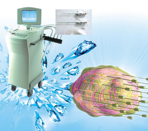 浙江腫瘤冷凍治療中心 浙江腫瘤冷凍治療中心