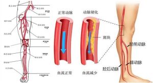 脛前動脈 脛前動脈