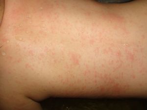 幼兒急疹 幼兒急疹