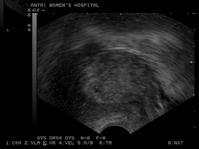功能性下丘腦性閉經