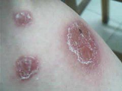 膿胞型牛皮癬 膿胞型牛皮癬