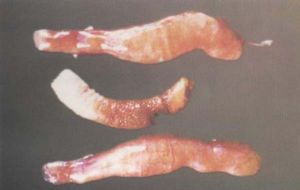 病雞盲腸腫大變粗，呈蚯蚓狀