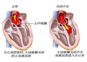 二尖瓣關閉不全