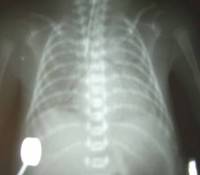 成人呼吸窘迫綜合徵 成人呼吸窘迫綜合徵