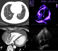 老年靜脈血栓症