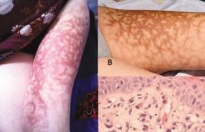 熱激紅斑 熱激紅斑