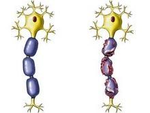 糖尿病性神經病 糖尿病性神經病