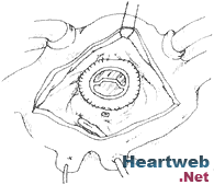 自體瓣膜心內膜炎