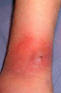 天火[中醫名詞]