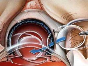 後房型人工晶體植入術