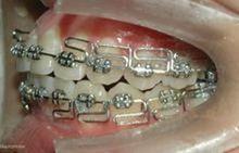 方絲弓矯治技術口內相