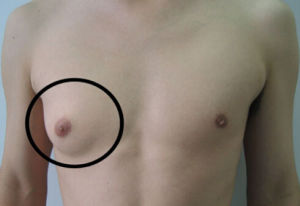 乳房發育症 乳房發育症