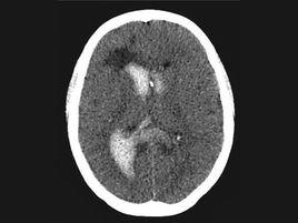 顱內出血 顱內出血
