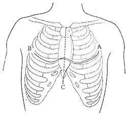 心包剝脫術 心包剝脫術