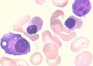 先天性純紅細胞再生障礙性貧血 先天性純紅細胞再生障礙性貧血