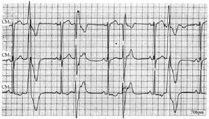 多源性室性早搏