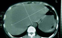 腎囊腫X射線