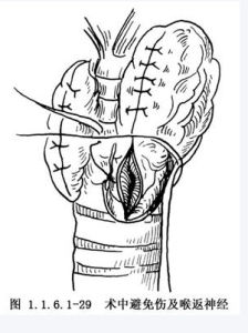 喉返神經損傷 喉返神經損傷