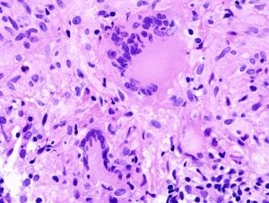 非典型分枝桿菌病