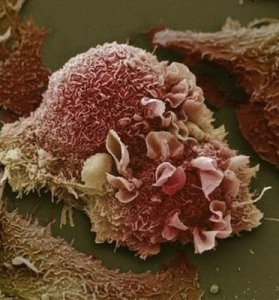 肺泡細胞癌 肺泡細胞癌