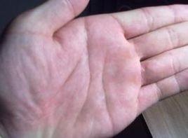 手與手指脹滿感 手與手指脹滿感