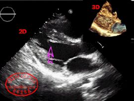 左室假腱索 左室假腱索