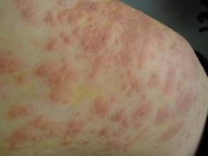 小兒丘疹性肢皮炎綜合徵 小兒丘疹性肢皮炎綜合徵