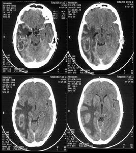 枕葉腫瘤 枕葉腫瘤