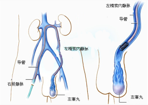 雙側精索靜脈曲張