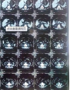 右腎囊腫 右腎囊腫