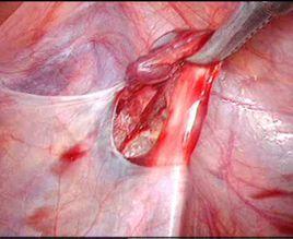 陰囊精索靜脈曲張 陰囊精索靜脈曲張