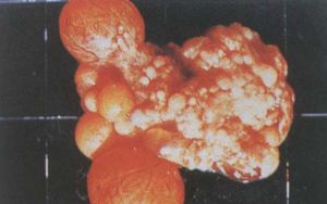 傷寒沙門氏菌感染雞的卵巢。可見像振子狀的異常卵泡
