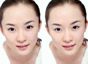 韓式雙眼皮術 韓式雙眼皮術