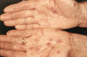 多形滲出性紅斑 多形滲出性紅斑