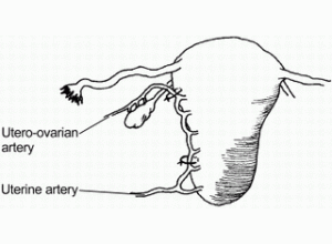 （圖）復發性卵巢惡性腫瘤