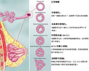 乳腺癌TNM分期