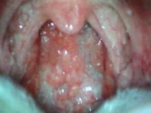 咽後壁淋巴濾泡增生