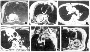 原發性肺動脈高壓