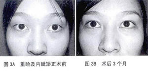 內眥贅皮修整術