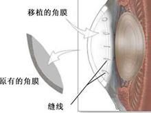 眼角膜移植
