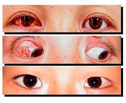 眼球後退綜合症特殊類型斜視 眼球後退綜合症特殊類型斜視