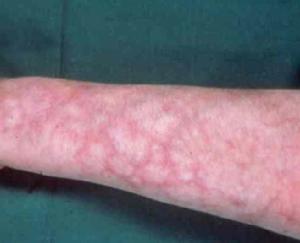 網狀青斑症 網狀青斑症