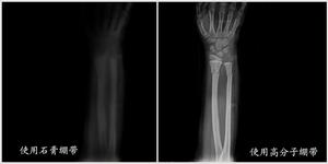高分子繃帶與傳統石膏效果圖