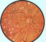 視網膜病變