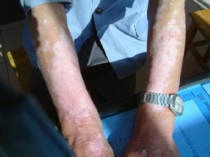 系統性紅斑狼瘡所致脊髓病