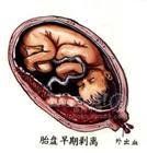 早期妊娠