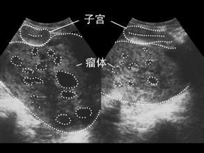 內胚竇瘤 內胚竇瘤