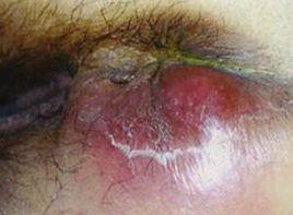 骶尾部急性膿腫 骶尾部急性膿腫